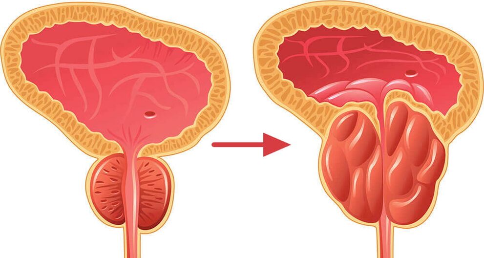 Prostate - normal and inflamed