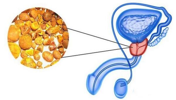 Calcina in the prostate gland