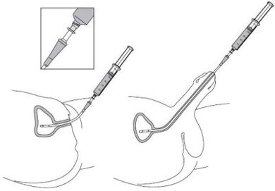 Instillation of a drug solution in the urethra
