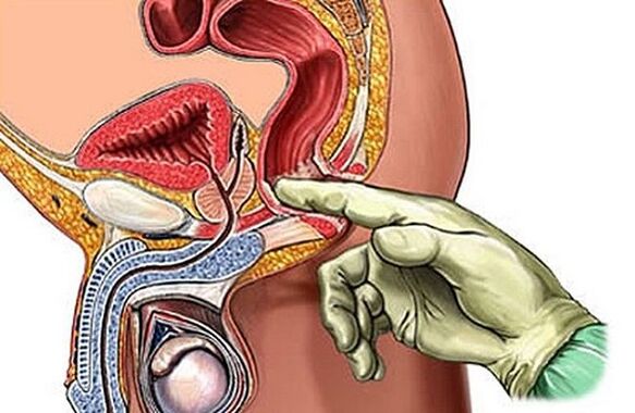 Prostate massage as a way to treat prostatitis